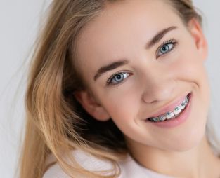 Blanqueamiento dental en Madrid