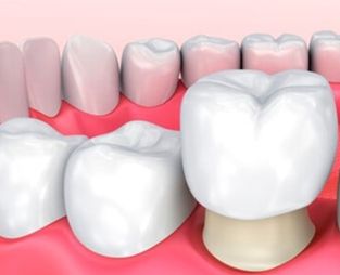 Tratamiento de coronas en Madrid