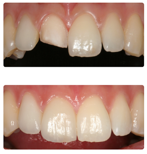 antes y despues carillas dental diente fracturado en madrid